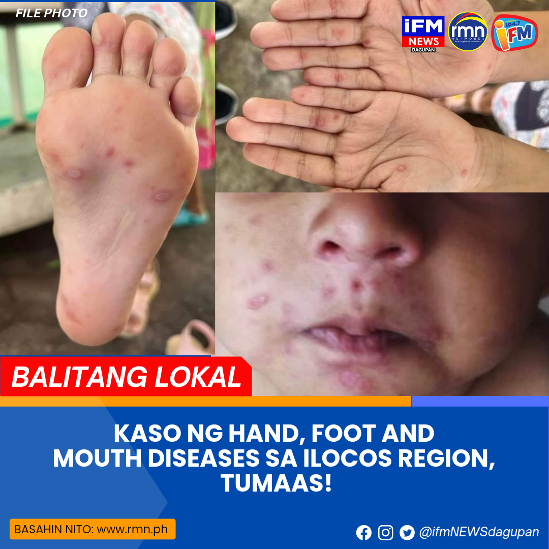 KASO NG HAND, FOOT AND MOUTH DISEASE SA ILOCOS REGION, TUMAAS RMN